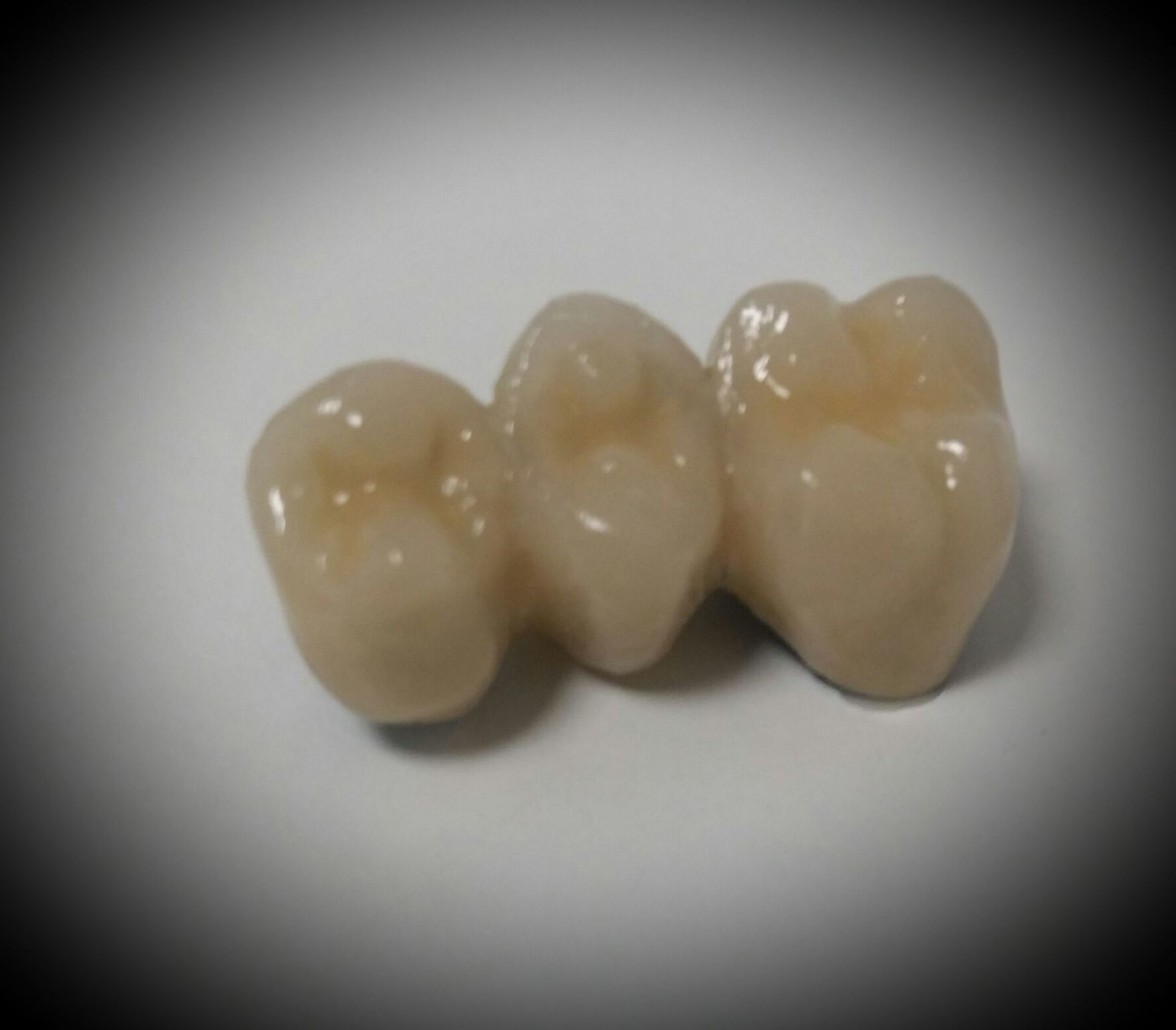 Prótesis fijas en metal sinterizado y fresado: Laboratorio Dental de Laboratorio de Prótesis Dental Prótesis fijas en metal sinterizado y fresado: Laboratorio Dental de Laboratorio de Prótesis Dental