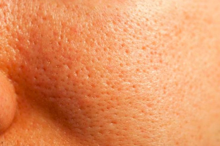 Poro dilatado: Tratamientos de Equilibra Estética Avanzada Poro dilatado: Tratamientos de Equilibra Estética Avanzada