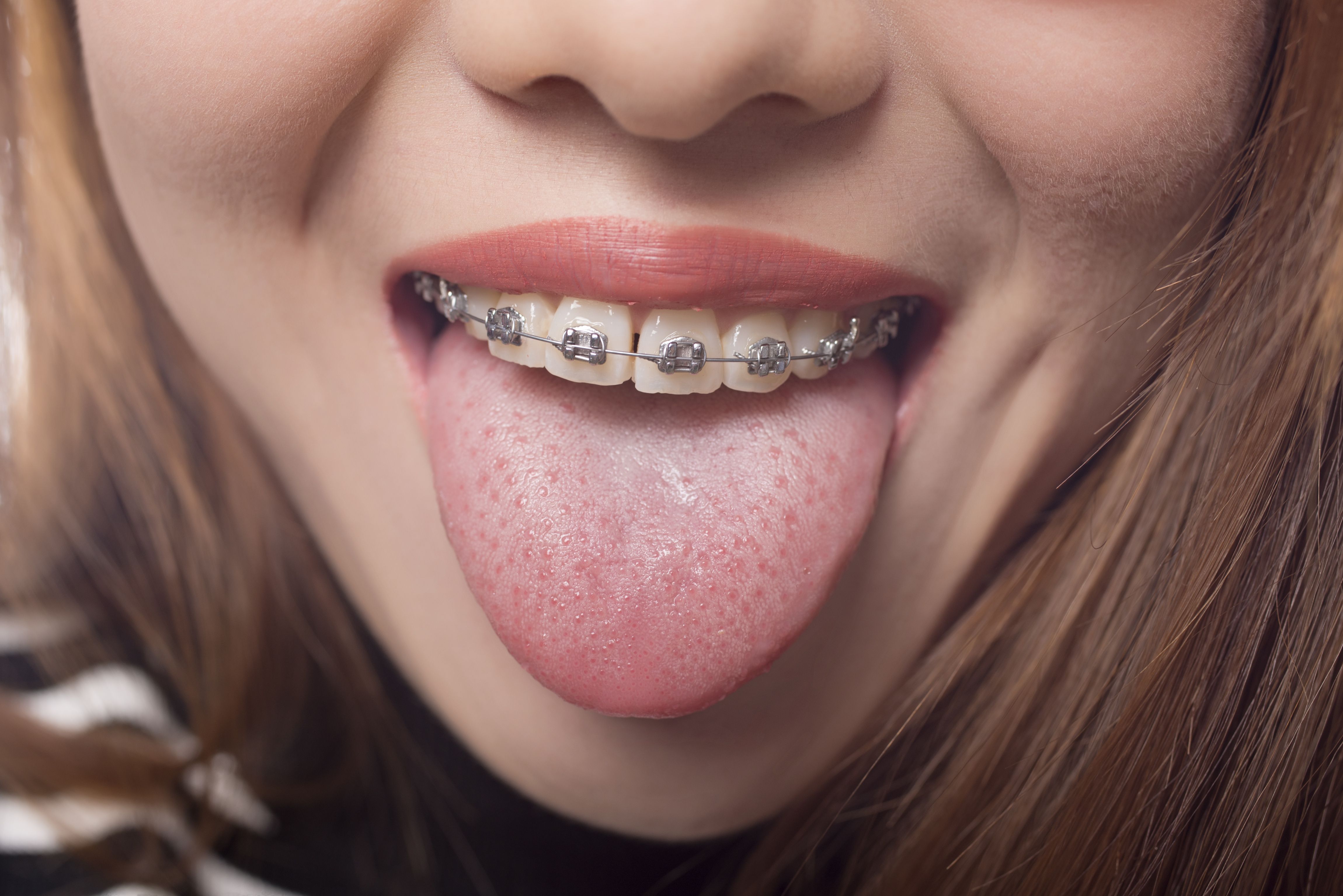 Ortodoncia convencional: Especialidades de Clínica Dental Vidal Ortodoncia convencional: Especialidades de Clínica Dental Vidal