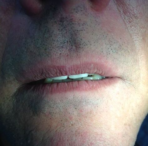 Caso clínico 5. Implantes dentales Madrid