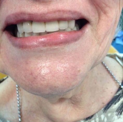 Caso Clínico 1. Implantes dentales Madrid