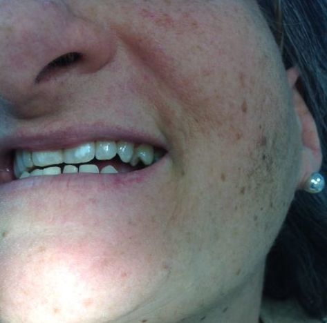 Caso clínico 7. Implantes dentales Madrid