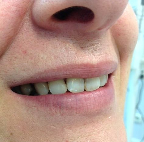 Caso clínico 6. Implantes dentales Madrid