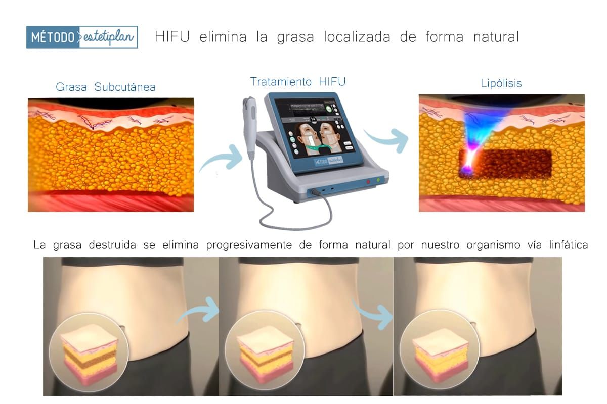 Tratamiento Hifu: Catálogo de Sedes Peluqueros Tratamiento Hifu: Catálogo de Sedes Peluqueros