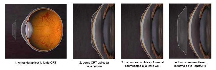 Ortoqueratología u Orto K : Catálogo de Natural Optics Vermas Ortoqueratología u Orto K : Catálogo de Natural Optics Vermas