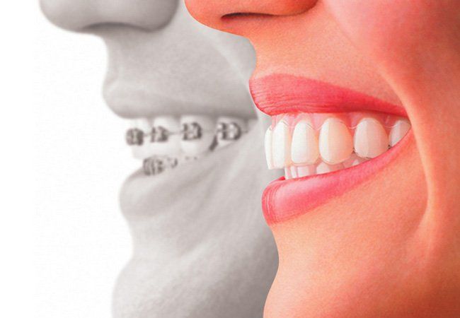 Ortodoncia (Invisalign): Servicios de Romo de Clínica Dental Romo }}