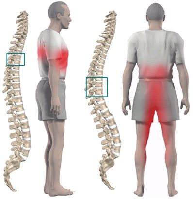 Tratamiento dorsalgia Fisiomas Murcia Tratamiento dorsalgia Fisiomas Murcia