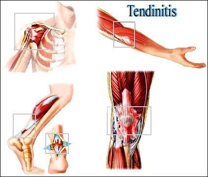 Tratamiento Tendinitis Fisiomas Murcia Tratamiento Tendinitis Fisiomas Murcia