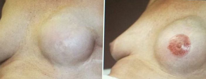 Camuflaje pezón y areola pechos: Servicios de C. López Camuflaje pezón y areola pechos: Servicios de C. López