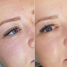 BB Glow - aplicación con dermapen-: Servicios de C. López BB Glow - aplicación con dermapen-: Servicios de C. López