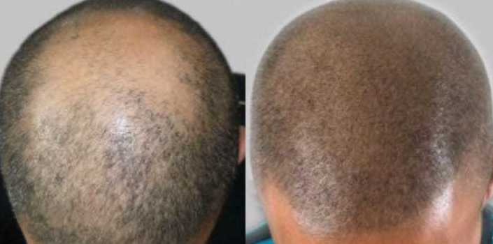Curso de Tricopigmentación o Micropigmentación Capilar: Servicios de C. López Curso de Tricopigmentación o Micropigmentación Capilar: Servicios de C. López