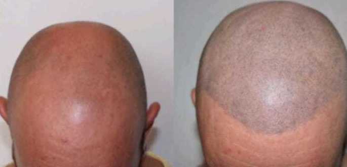 Micropigmentación Capilar (Tricopigmentación): Servicios de C. López Micropigmentación Capilar (Tricopigmentación): Servicios de C. López