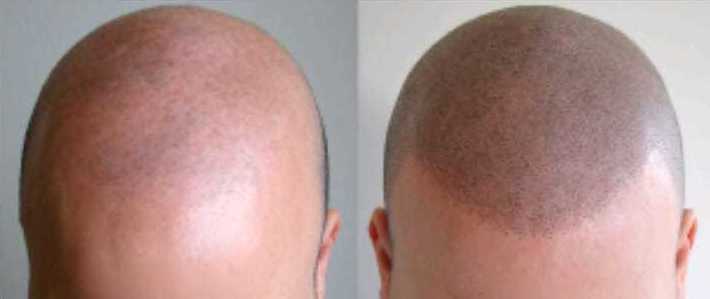 Micropigmentación Capilar (Tricopigmentación): Servicios de C. López Micropigmentación Capilar (Tricopigmentación): Servicios de C. López