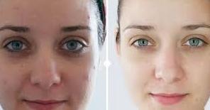 Dermoabrasión: Estética facial: Servicios de C. López Dermoabrasión: Estética facial: Servicios de C. López