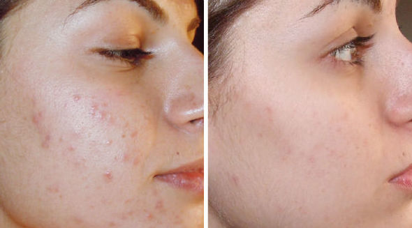Curso Dermapen: Servicios de C. López Curso Dermapen: Servicios de C. López