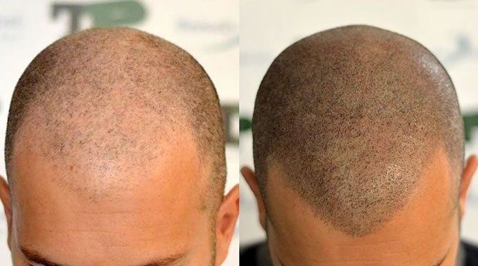 Curso de Tricopigmentación o micropigmentación capilar on line: Servicios de Beauty Channel Curso de Tricopigmentación o micropigmentación capilar on line: Servicios de Beauty Channel