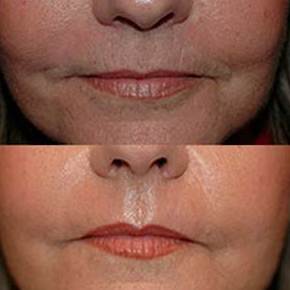 Dermoabrasión: Estética facial: Servicios de C. López Dermoabrasión: Estética facial: Servicios de C. López