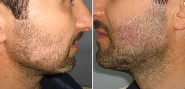 Curso de Tricopigmentación o micropigmentación capilar on line: Servicios de Beauty Channel Curso de Tricopigmentación o micropigmentación capilar on line: Servicios de Beauty Channel