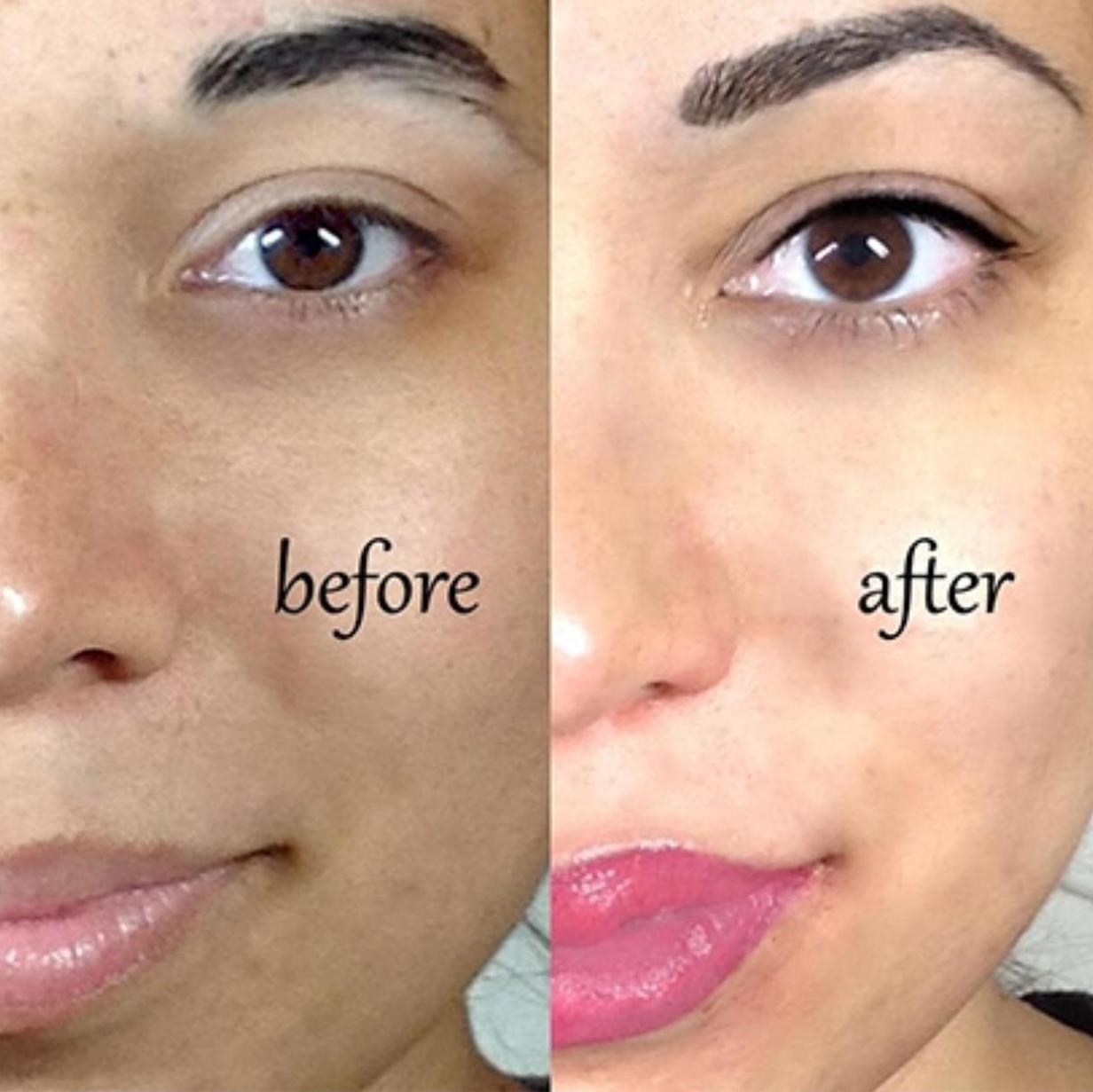 BB Glow - aplicación con dermapen-: Servicios de C. López BB Glow - aplicación con dermapen-: Servicios de C. López