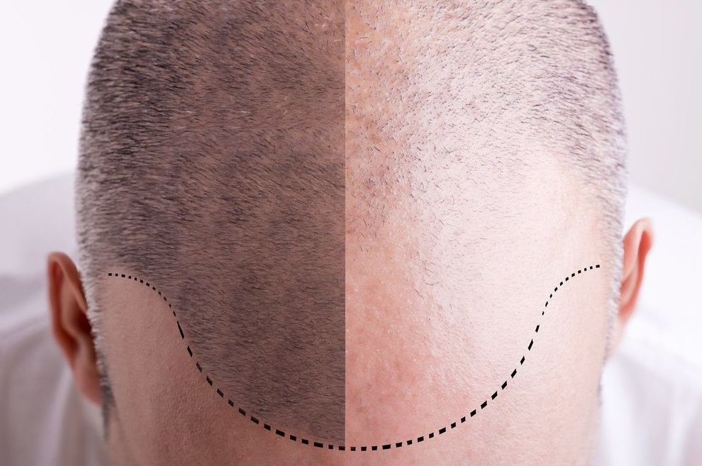 Curso de Tricopigmentación o micropigmentación capilar on line: Servicios de Beauty Channel Curso de Tricopigmentación o micropigmentación capilar on line: Servicios de Beauty Channel