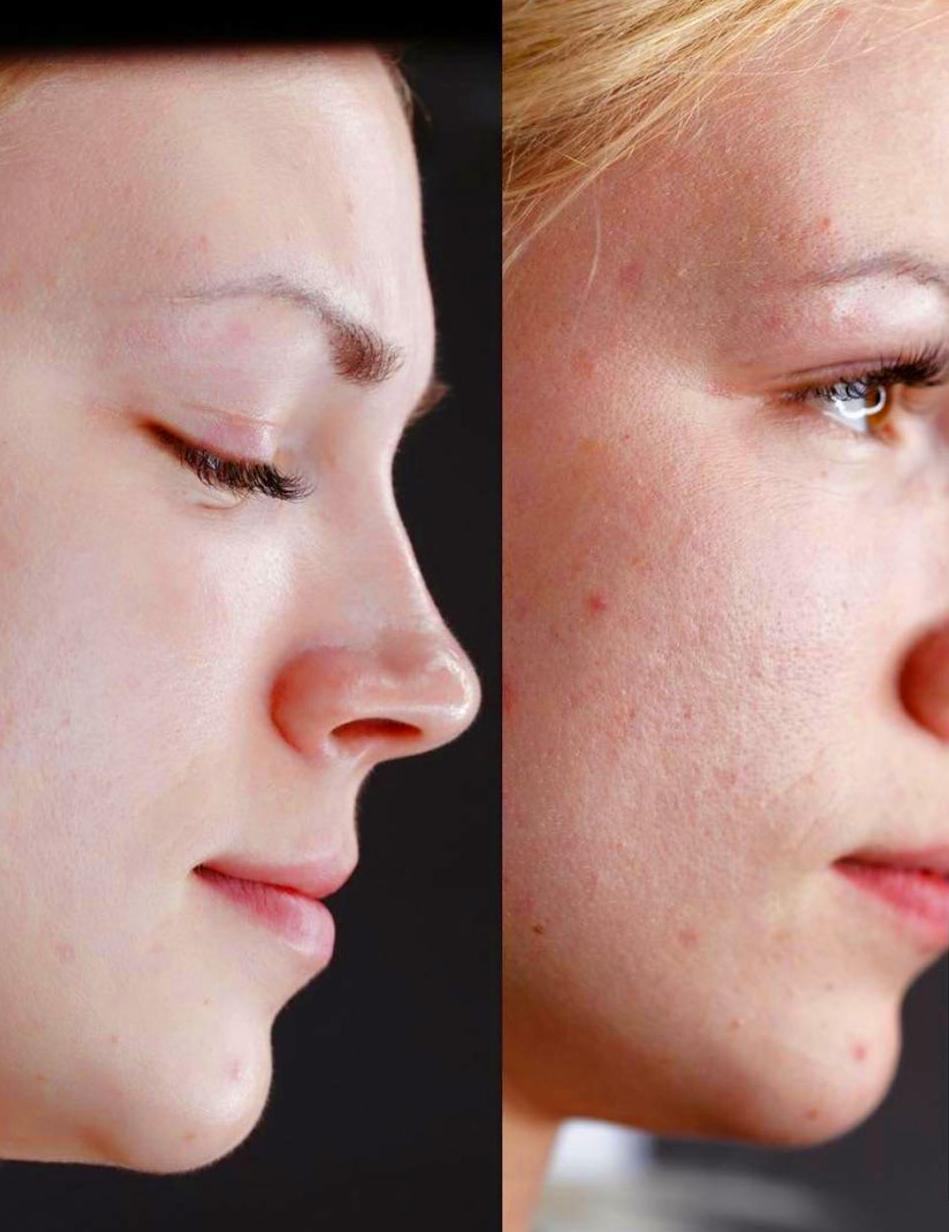 BB Glow - aplicación con dermapen-: Servicios de C. López BB Glow - aplicación con dermapen-: Servicios de C. López