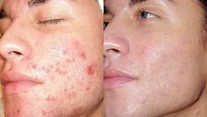 Dermoabrasión: Estética facial: Servicios de C. López Dermoabrasión: Estética facial: Servicios de C. López