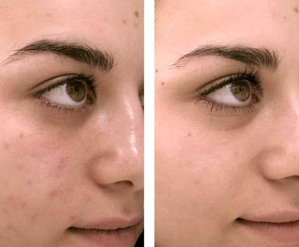 Curso Dermapen: Servicios de C. López Curso Dermapen: Servicios de C. López