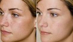 Dermoabrasión: Estética facial: Servicios de C. López Dermoabrasión: Estética facial: Servicios de C. López