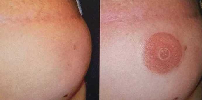 Camuflaje pezón y areola pechos: Servicios de C. López Camuflaje pezón y areola pechos: Servicios de C. López