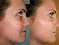 BB Glow - aplicación con dermapen-: Servicios de C. López BB Glow - aplicación con dermapen-: Servicios de C. López