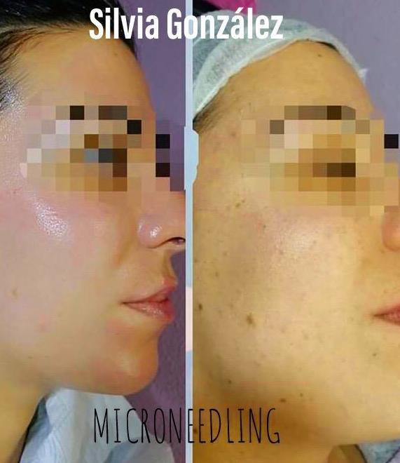 BB Glow - aplicación con dermapen-: Servicios de C. López BB Glow - aplicación con dermapen-: Servicios de C. López