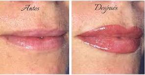 Micropigmentación de Labios: Servicios de Beauty Channel Micropigmentación de Labios: Servicios de Beauty Channel