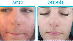 Dermoabrasión: Estética facial: Servicios de C. López Dermoabrasión: Estética facial: Servicios de C. López