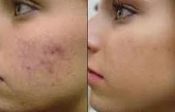Dermoabrasión: Estética facial: Servicios de C. López Dermoabrasión: Estética facial: Servicios de C. López