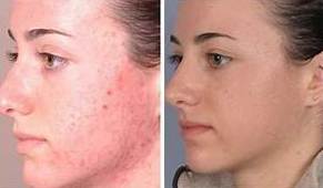 Dermoabrasión: Estética facial: Servicios de C. López Dermoabrasión: Estética facial: Servicios de C. López