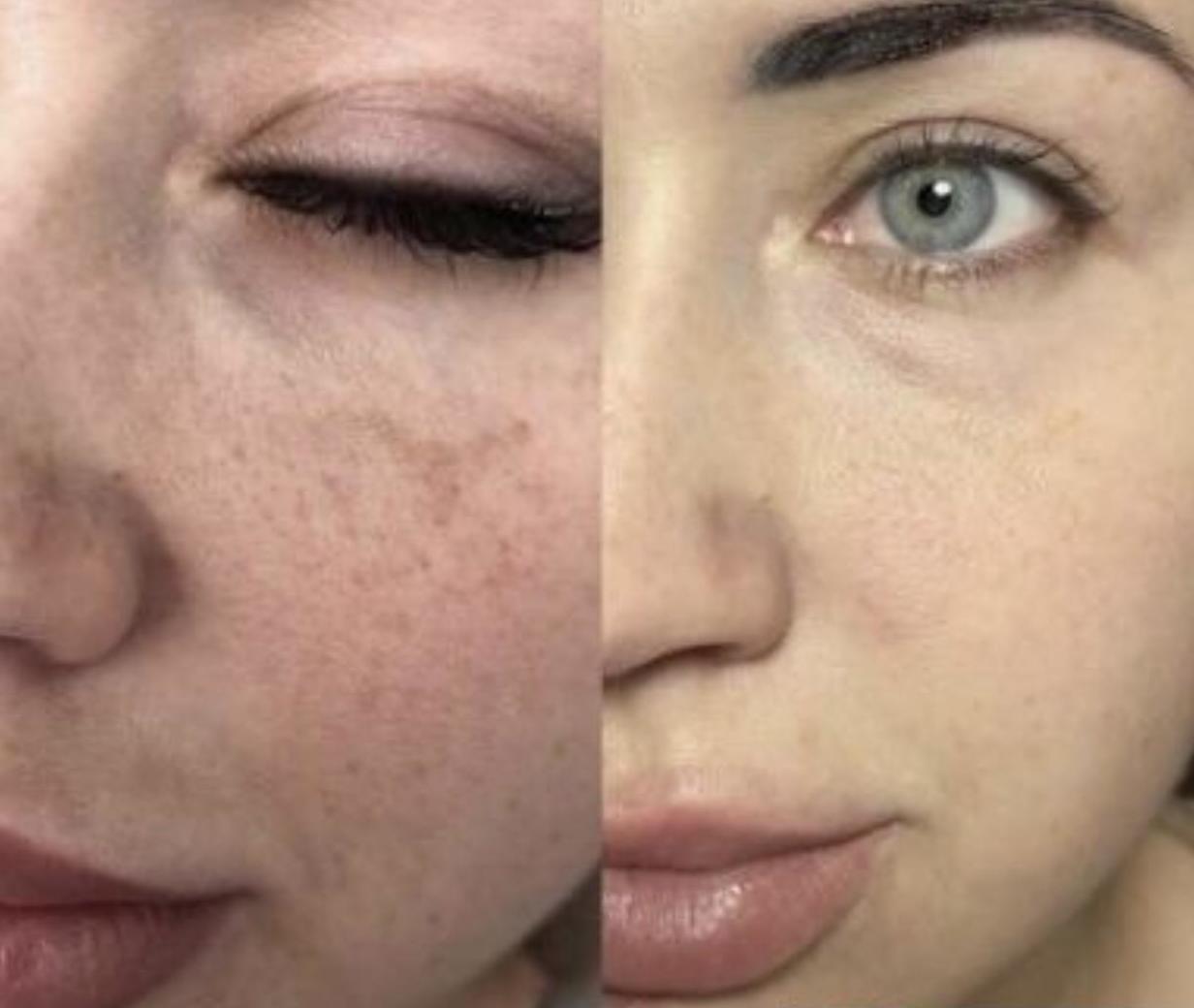 BB Glow - aplicación con dermapen-: Servicios de C. López BB Glow - aplicación con dermapen-: Servicios de C. López