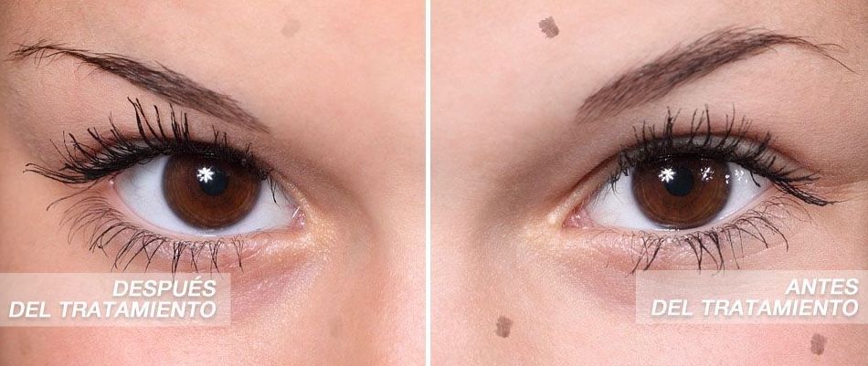 Micropigmentación pecas y lunares: Servicios de C. López Micropigmentación pecas y lunares: Servicios de C. López