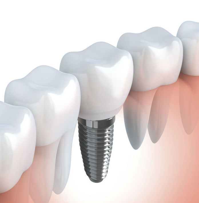 Implantología y prótesis sobre implantes: Tratamientos de Clínica Dental Xixón }}