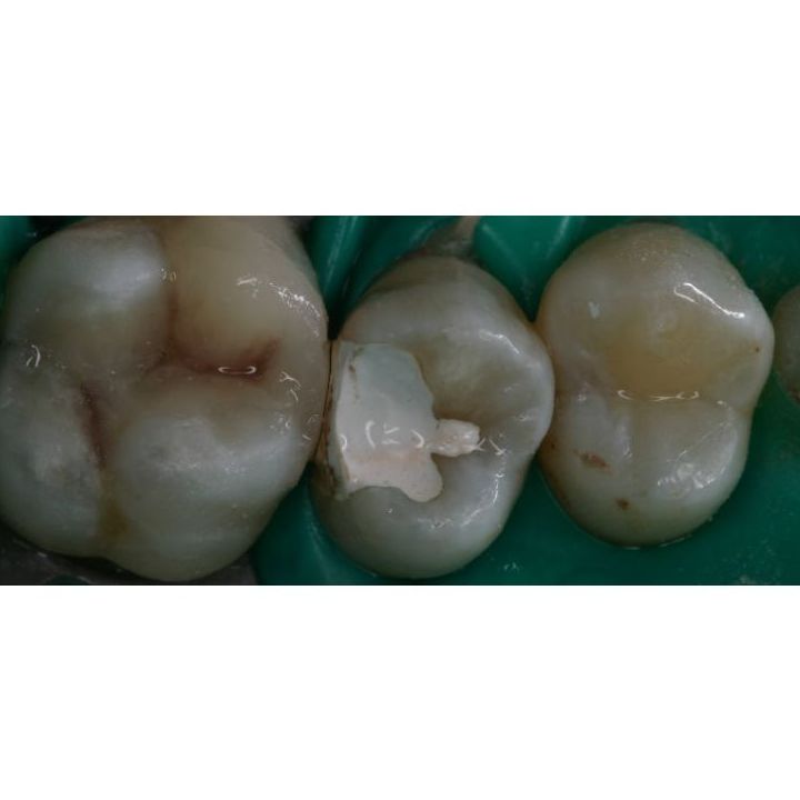 Empaste : Especialidades de Clínica San Francisco de Alcalá Empaste : Especialidades de Clínica San Francisco de Alcalá