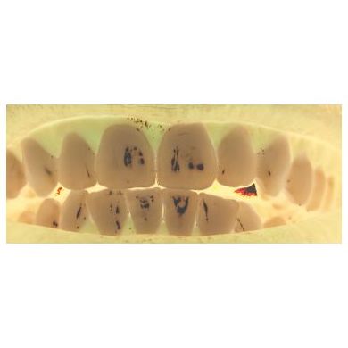 Prótesis dental : Especialidades de Clínica San Francisco de Alcalá Prótesis dental : Especialidades de Clínica San Francisco de Alcalá