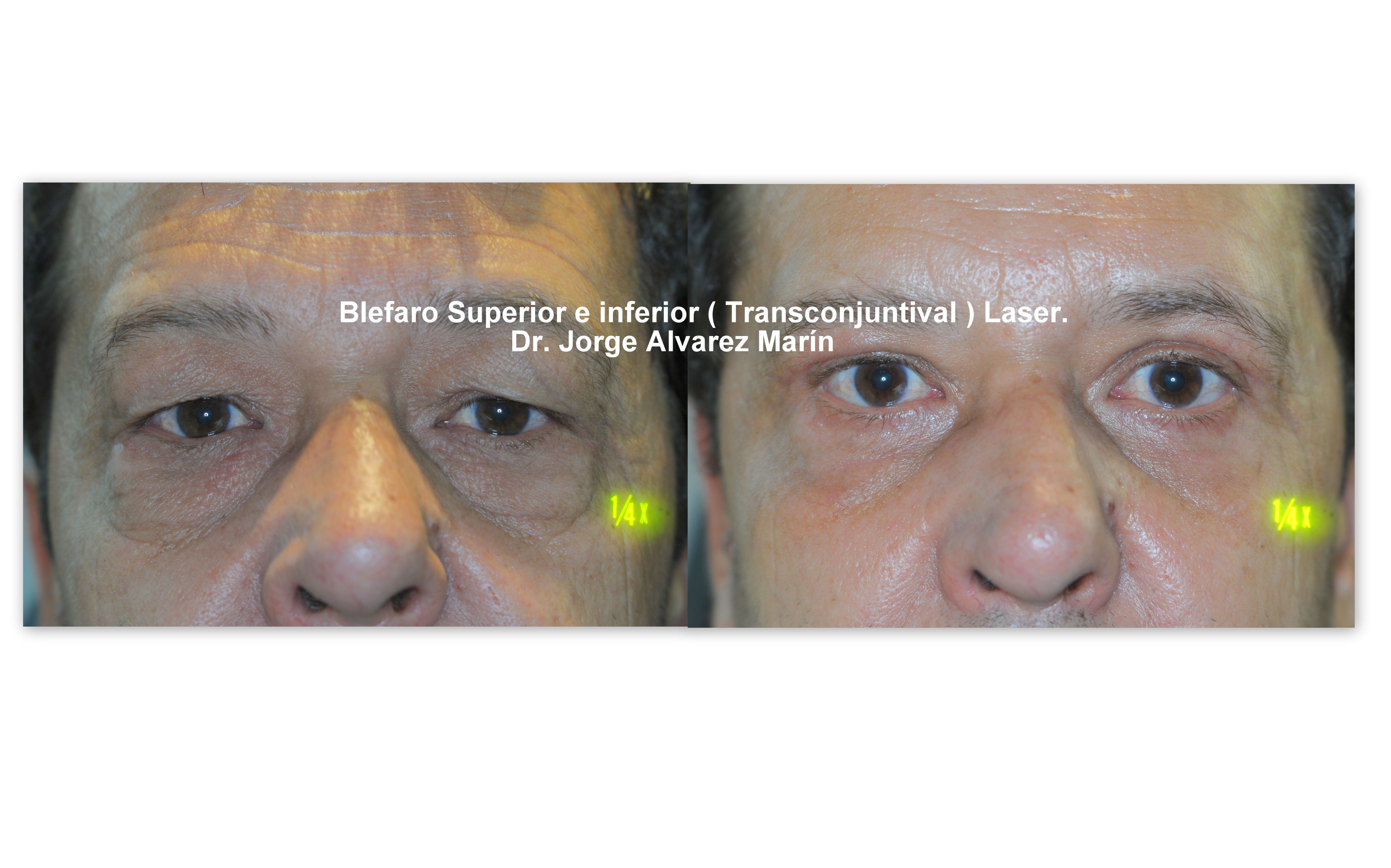Paciente intervenido por el Dr. Jorge Alvarez Marin Blefaroplastia Superior con Laser