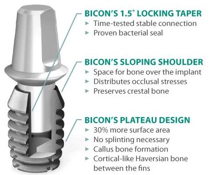 Implantes Especiales : Especialidades de Centre Odontològic Idzi Implantes Especiales : Especialidades de Centre Odontològic Idzi