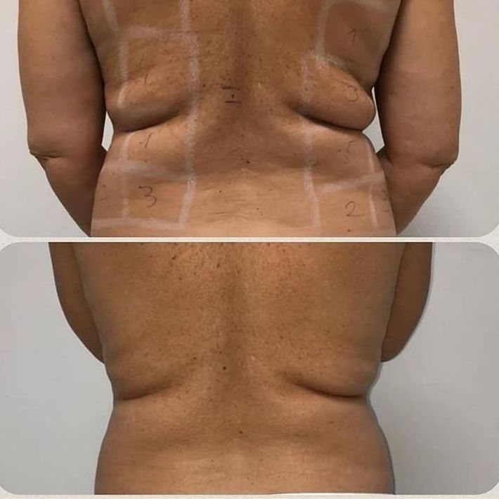 Liposucción sin cirugía barrio del pilar : Servicios de Duoestetica Liposucción sin cirugía barrio del pilar : Servicios de Duoestetica
