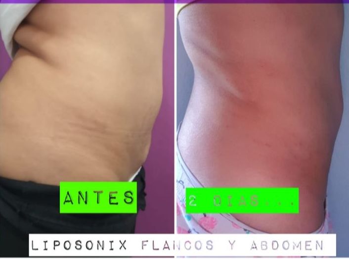 Liposucción sin cirugía barrio del pilar : Servicios de Duoestetica Liposucción sin cirugía barrio del pilar : Servicios de Duoestetica