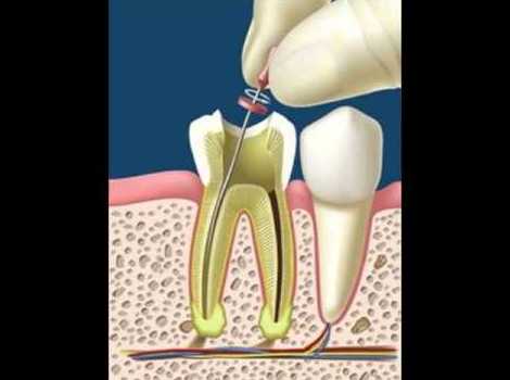 Endodoncia: Tratamientos dentales de Dental Llorens. Viché & Gutiérrez