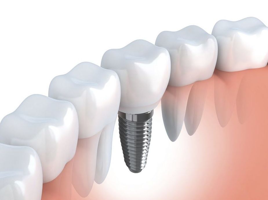 Implantes dentales: Tratamientos dentales de Dental Llorens. Viché & Gutiérrez