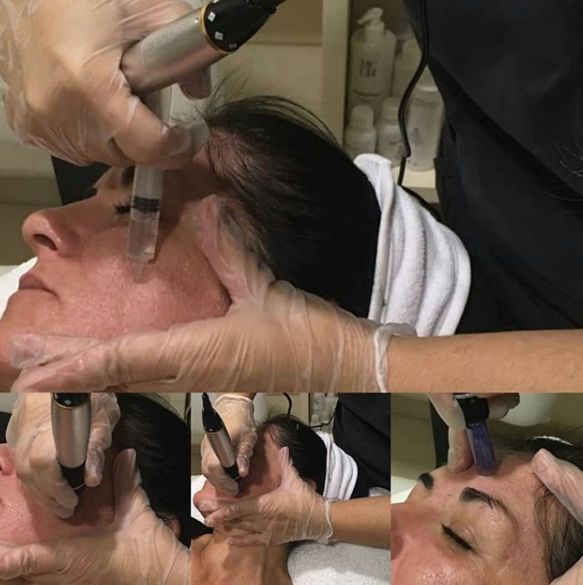 Dermapen: Tratamientos de Beauty Room Dermapen: Tratamientos de Beauty Room