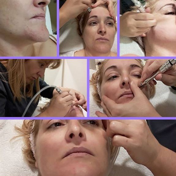 Microdermoabrasión con punta de diamante: Tratamientos de Beauty Room Microdermoabrasión con punta de diamante: Tratamientos de Beauty Room