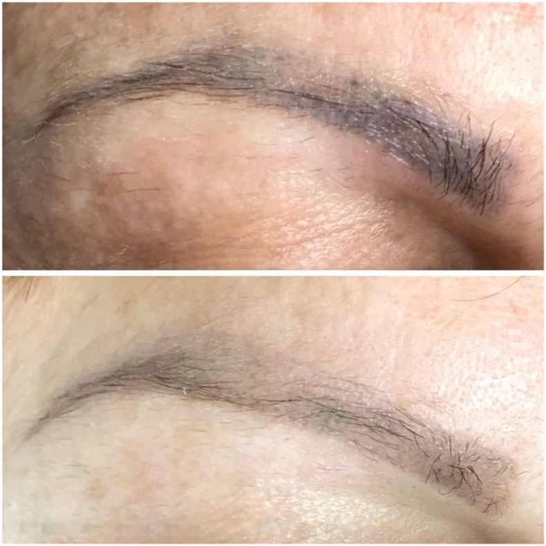 Eliminación de Micropigamentación de cejas, ojos y labios: Servicios de Bodybrite Majadahonda Eliminación de Micropigamentación de cejas, ojos y labios: Servicios de Bodybrite Majadahonda