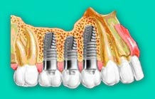 Implantes dentales Implantes dentales